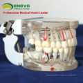 DENTAL07 (12566) modèle pathologique transparent adulte de dents pour l&#39;étude et la communication dentaires